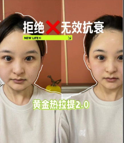 黄金热拉提多少钱一次？钱包要 “瘦身” 多少？