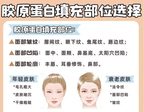 骨胶原填充面部价格多少？脸蛋营养得花在点子上