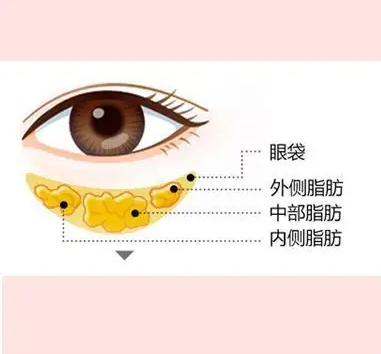 去眼袋整容医院挂什么科？给 “熊猫眼” 找对 “主治医生”