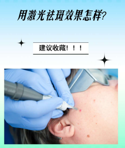 激光去斑有效吗？从斑点类型看 “光与色素的对抗结果”