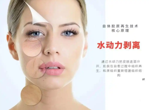 水剥离祛眼袋能维持多久？结合具体案例和对比表，详细说说