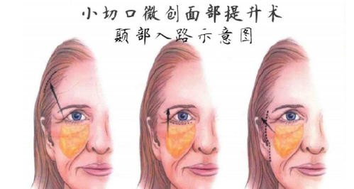 颞部提升手术的弊端有哪些? “绷紧的弦” 藏着隐患