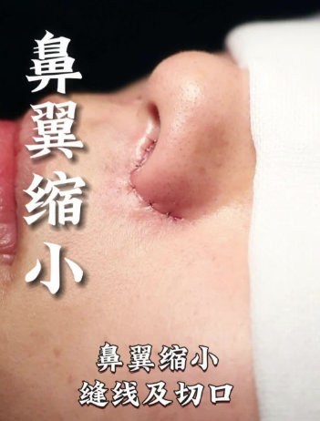 鼻翼缩小切口多久愈合？看这些 “伤口变美记” 就知道