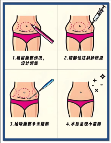 武汉做腰腹环吸比较好的医院，看看哪家更合心意？