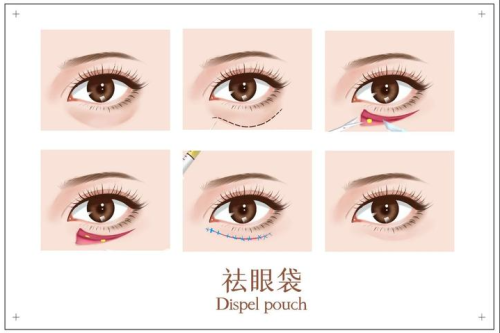 割眼袋算小手术吗?有的轻松有的麻烦