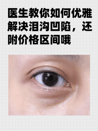 泪沟凹陷怎么解决好?不同情况给出针对性选择建议