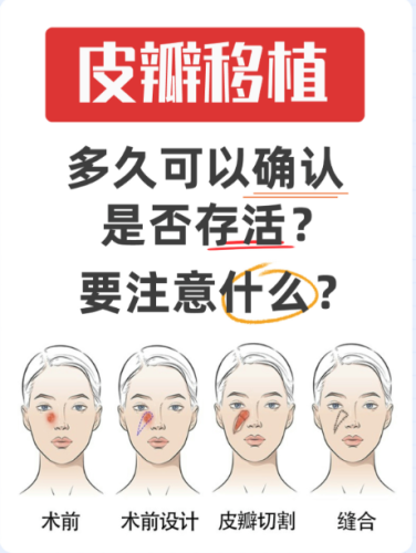 微粒皮移植最佳供皮区 :从临床实践看部位选择