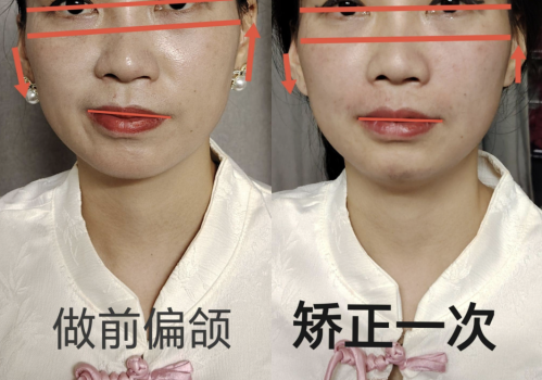 下颌骨不对称整形效果能维持多久?风险大不大?