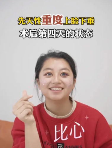 先天性上脸下垂是什么原因造成的?可以手术矫正吗?