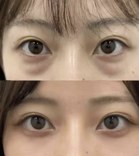 沈阳杏林眼袋做的好的医生是谁？好口碑都在这里