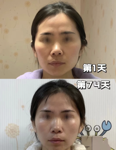 颧骨内推手术风险高吗？到底有多离谱？