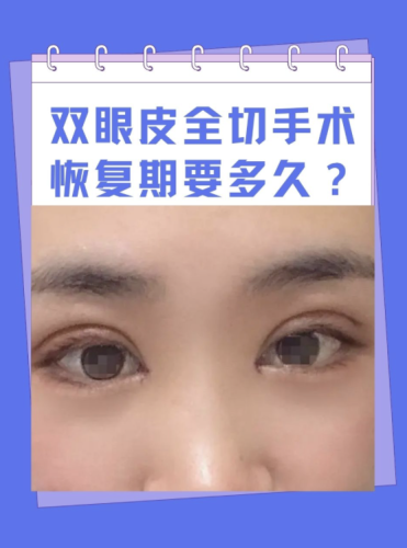割双眼皮多久能恢复正常