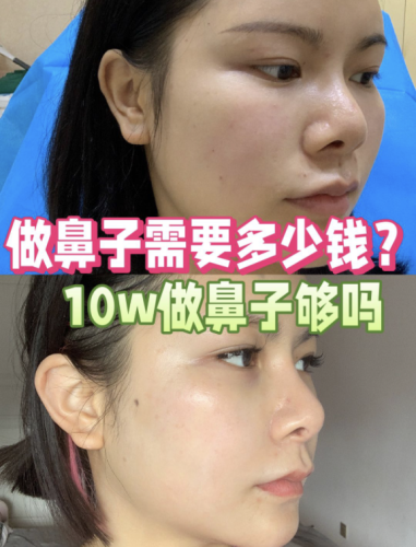 常州第七人民医院做鼻子多少钱？10w够吗