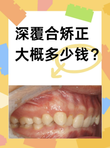 深覆合矫正需要多少钱？一文读懂费用背后的秘密