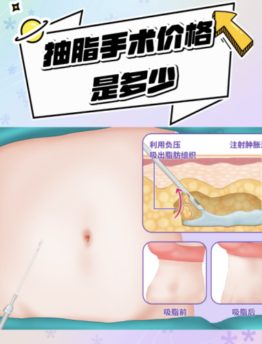 东莞厚街医院抽脂好吗？价格差异化在哪
