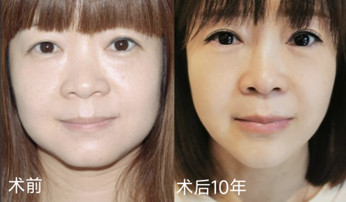 淄博第一医院拉皮除皱多少钱？部位不同，直接导致价格差异