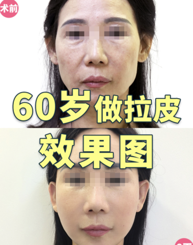 呼和浩特第一医院拉皮除皱多少钱？效果能维持多久？