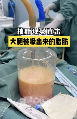 大石桥中心医院抽脂好吗？价格又是怎样的呢？接下来为你详细揭秘
