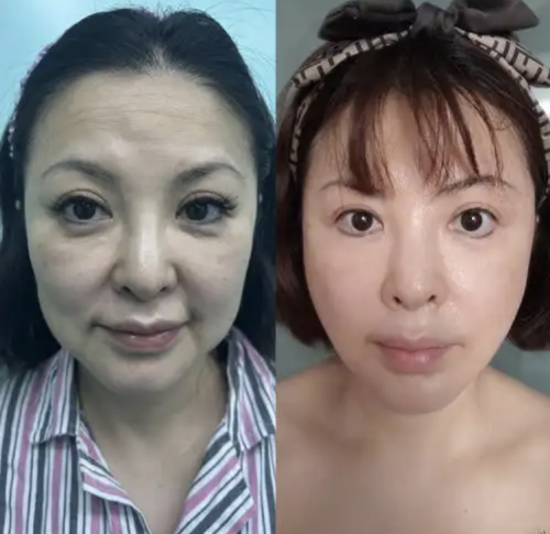 杭州萧山区中医院拉皮除皱多少钱？看完直接拿捏预算～