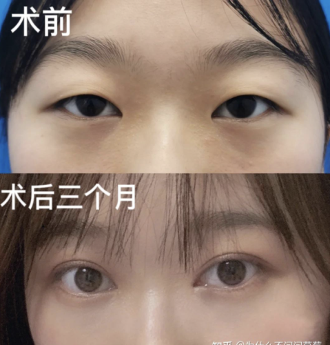 成都中西医结合医院割双眼皮多少钱?扒一扒双眼皮的真实价位