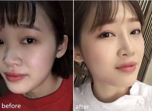 河北省沧州中西医结合医院隆鼻怎么样?能应对各种复杂的鼻部整形问题