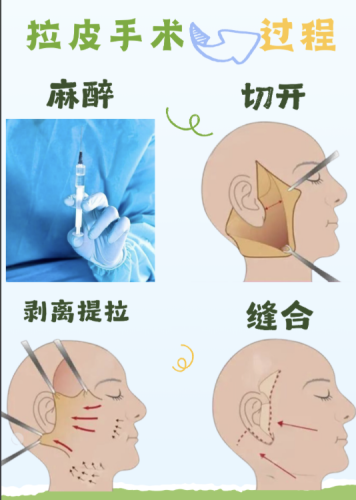哈医大二院除皱手术怎么样？皱新技术、新方法，走在行业前沿