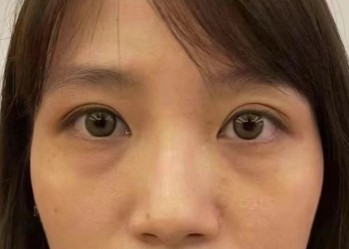 胶原蛋白填充眼袋有啥害处？告诉你真相