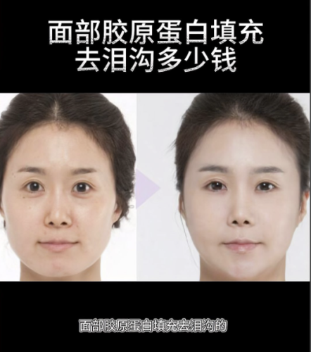 填泪沟多少钱？受到多种因素的交织影响