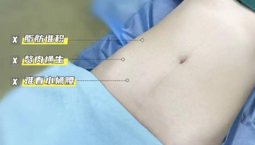 腰腹环吸加黄金微雕多少钱？案例展示