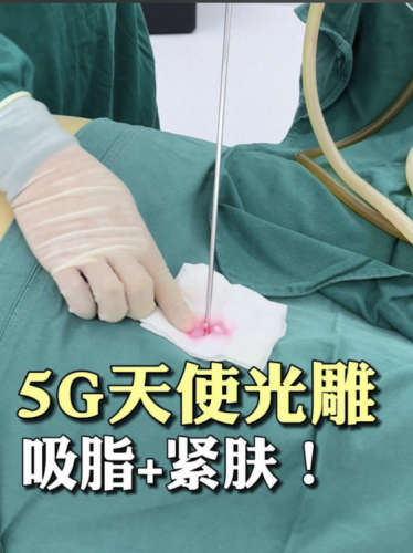 5g天使光雕恢复期有多久？面部1-3个月、腰腹和大腿3-6个月能恢复自然
