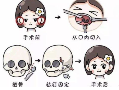 磨骨手术风险大吗?需要多少钱?全面了解一下手术风险程度及费用情况