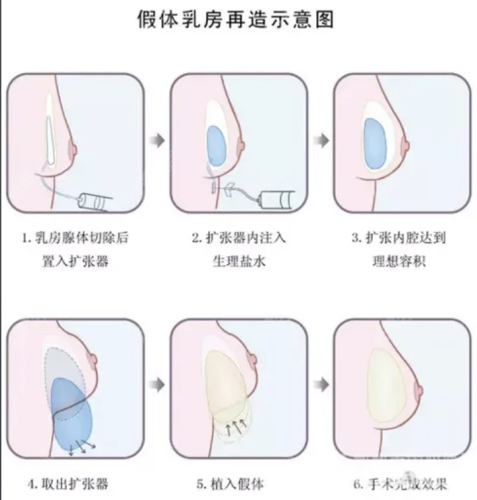 北京地坛医院丰胸手术怎么样?强大的医生阵容为开展丰胸手术奠定了坚实基础