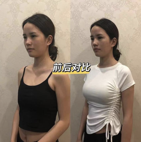 新余人民医院隆胸多少钱？从手术方式到具体花费，给大家做个详细说明