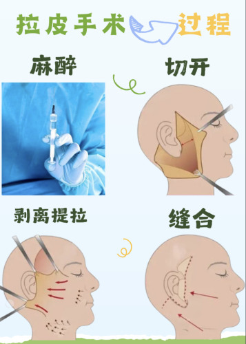 河北省沧州中西医结合医院拉皮除皱多少钱？结合自己的面部情况、预算，选最适合自己的方案
