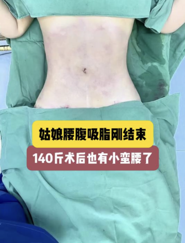 兰州大学第二医院吸脂怎么样？3个月后肚子上的脂肪直接少了45%