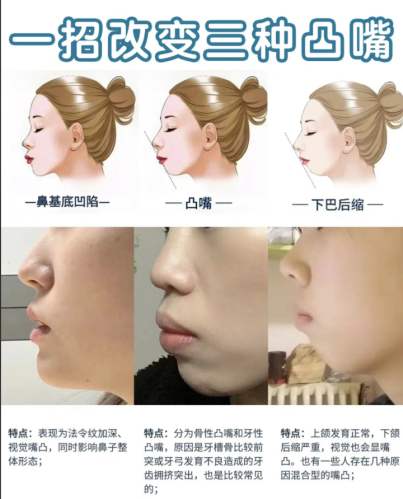 嘴凸的几种类型：来看看你是哪种类型牙齿 “调皮” 惹的祸