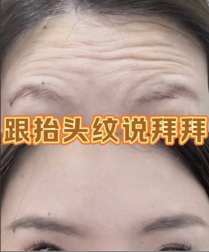 玻尿酸抬头纹要打几只？0.5ml拯救“表情纹”