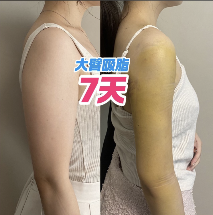抽脂瘦手臂要多少钱？从 6 千到 3 万，差在哪？