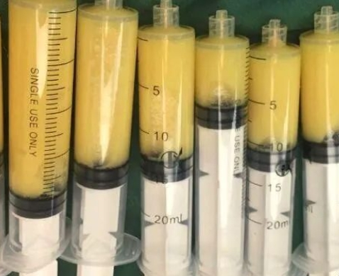 脂肪增粗手术要多少钱？价格区间、影响因素全解析