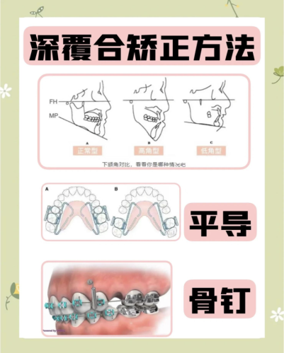 深覆合矫正方法：方法大盘点，变身 “微笑达人” 不是梦
