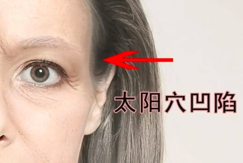 太阳凹陷修复好的办法？方法大全+解答