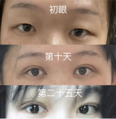 哈尔滨超龙做双眼皮怎么样？8000㎡变美基地的底气