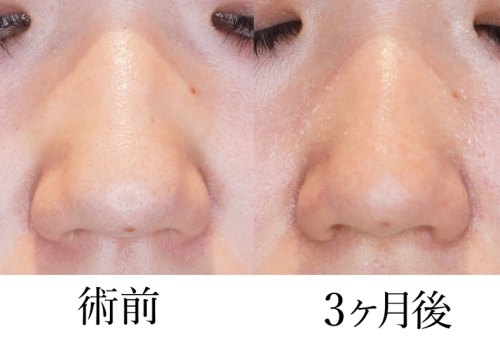 鼻翼缩小术要多少钱呢？了解价格真的很重要