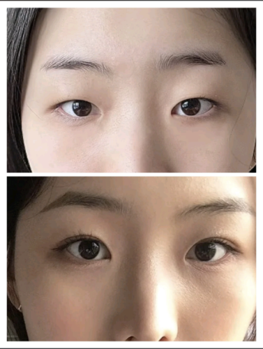 哈尔滨超龙双眼皮案例：3种眼型的逆袭之路