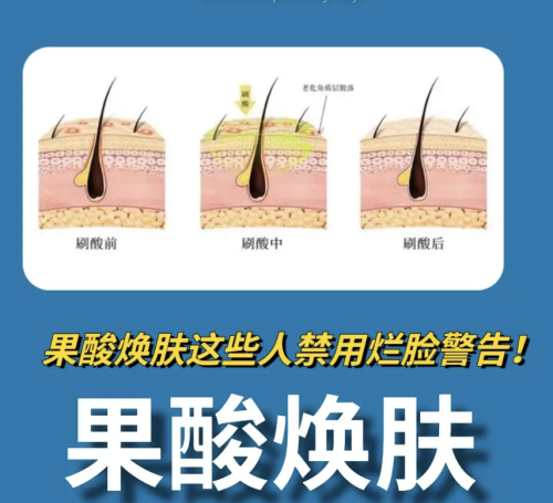 新沂人民医院美容科项目价格：果酸焕肤380元-880元，平价不平庸