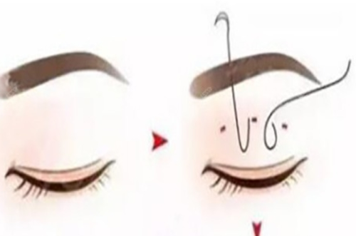定点双眼皮多少钱？带你从钱包到眼皮全算清！