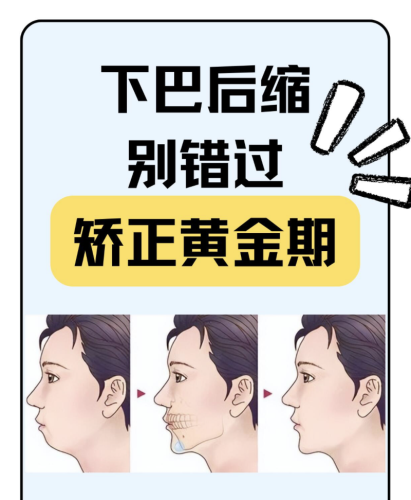 下巴后缩手术多少钱？据不完全统计，单次手术费用大概8000-15000元