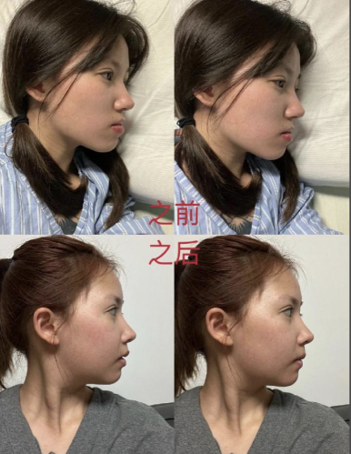 正颌手术后最难熬的三个阶段：今天来给大伙好好唠唠，提前做好心理准备，轻松闯关！