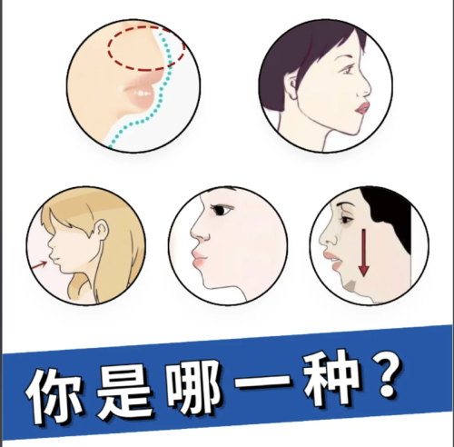 嘴凸怎么矫正？70% 的嘴凸是牙性 + 功能性混合，来30 秒对号入座