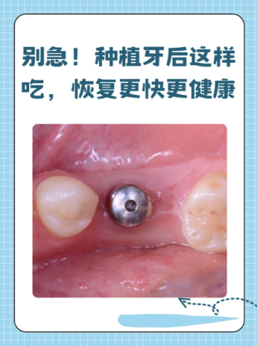 广州第一人民医院种植牙怎么样?从术前检查到术后维护,全流程兜底